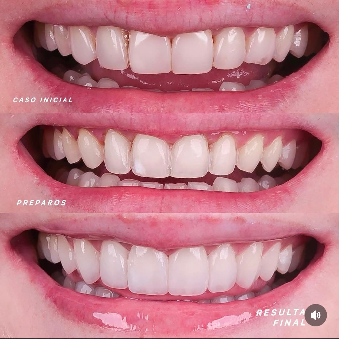 Caso real de facetas em porcelana, antes e depois, tratamento com Dr. João Pedro Brandão