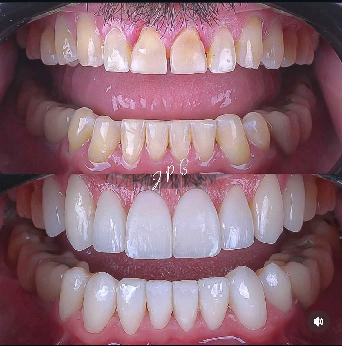 Caso real de facetas em porcelana, antes e depois, tratamento com Dr. João Pedro Brandão