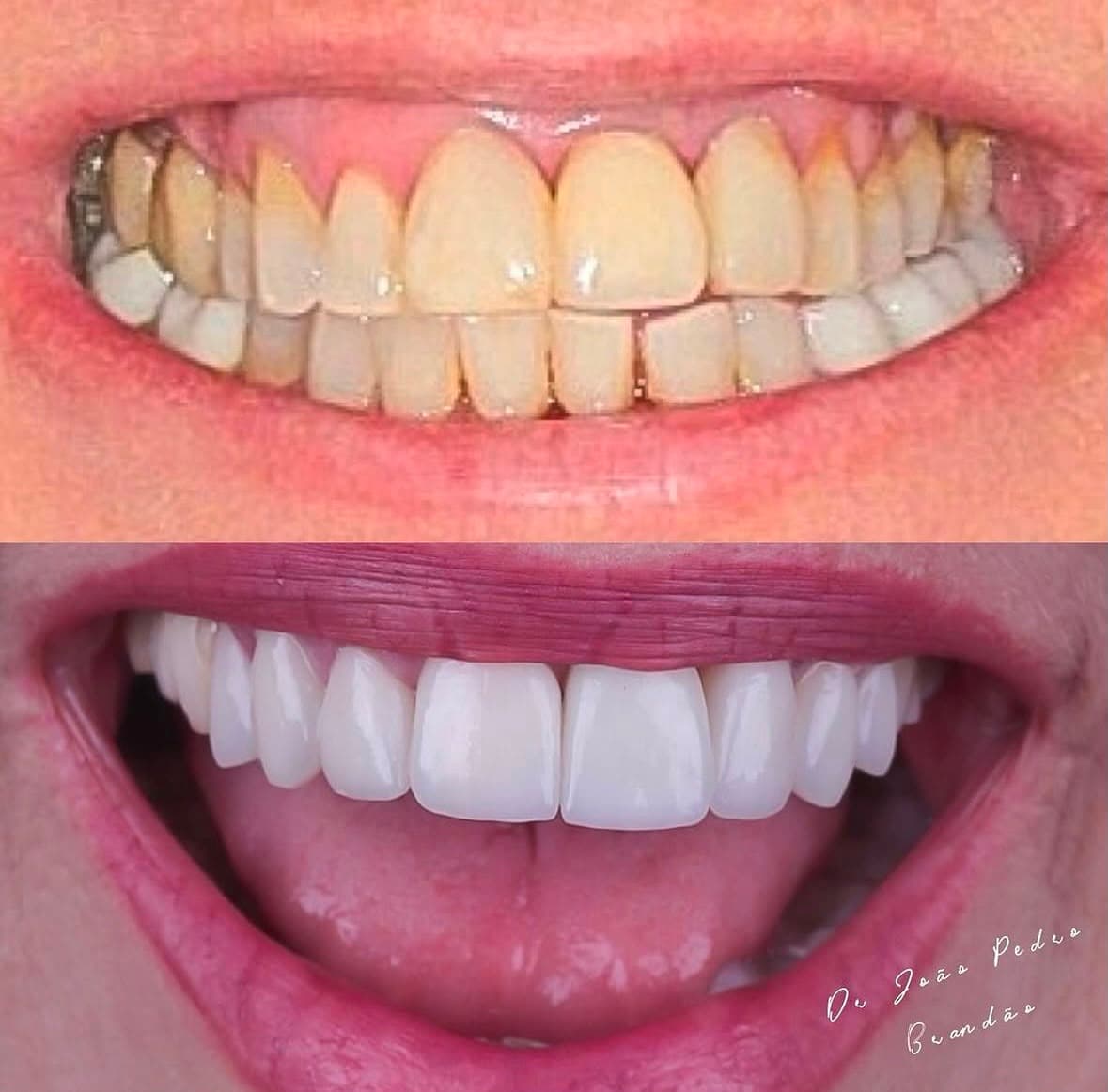 Caso real de facetas em porcelana, antes e depois, tratamento com Dr. João Pedro Brandão