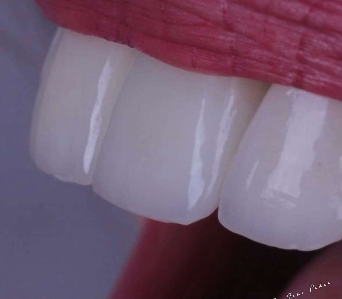 Caso real de facetas em porcelana, antes e depois, tratamento com Dr. João Pedro Brandão