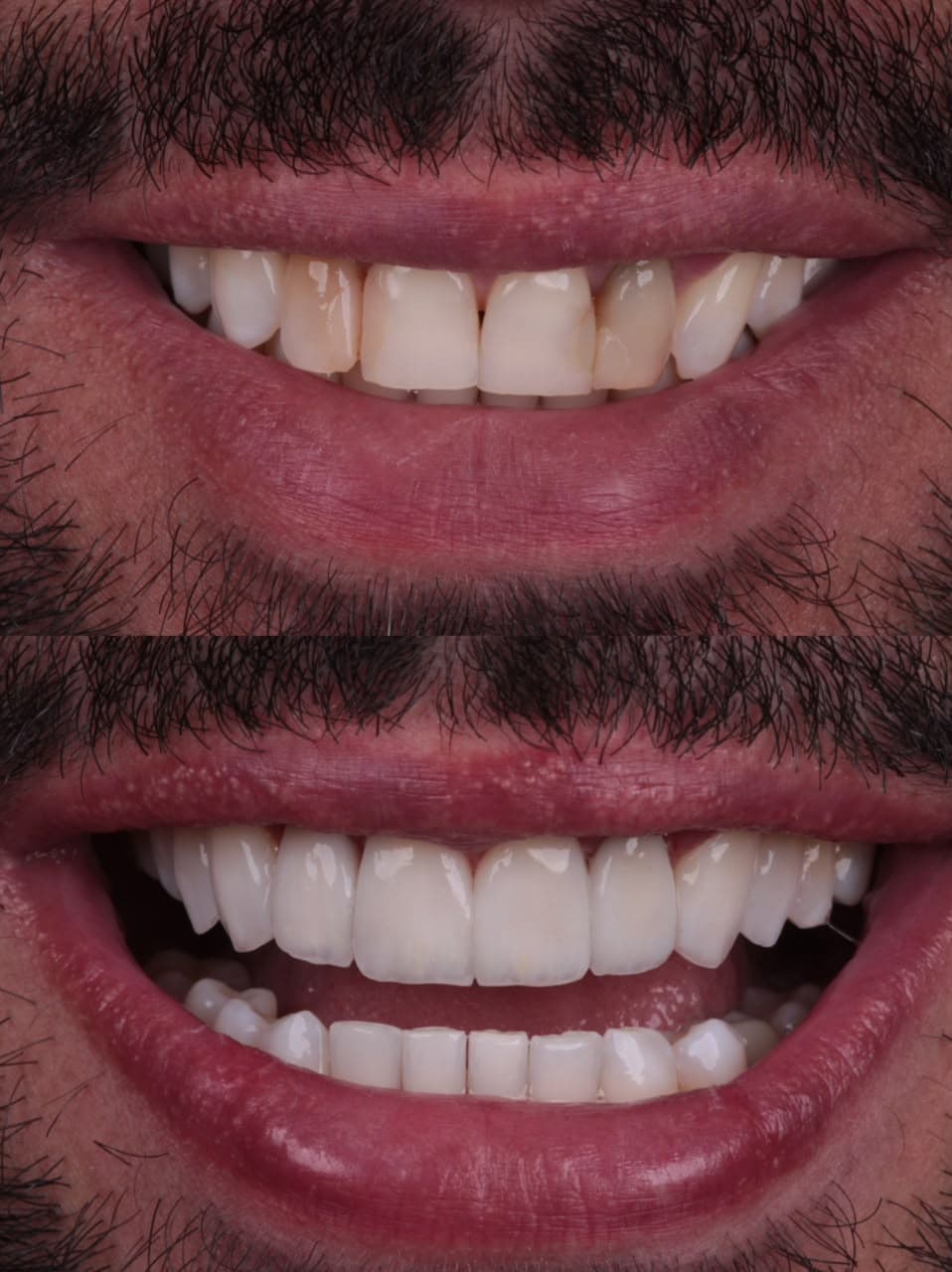 Caso real de facetas em resina composta, antes e depois, tratamento com Dr. João Pedro Brandão
