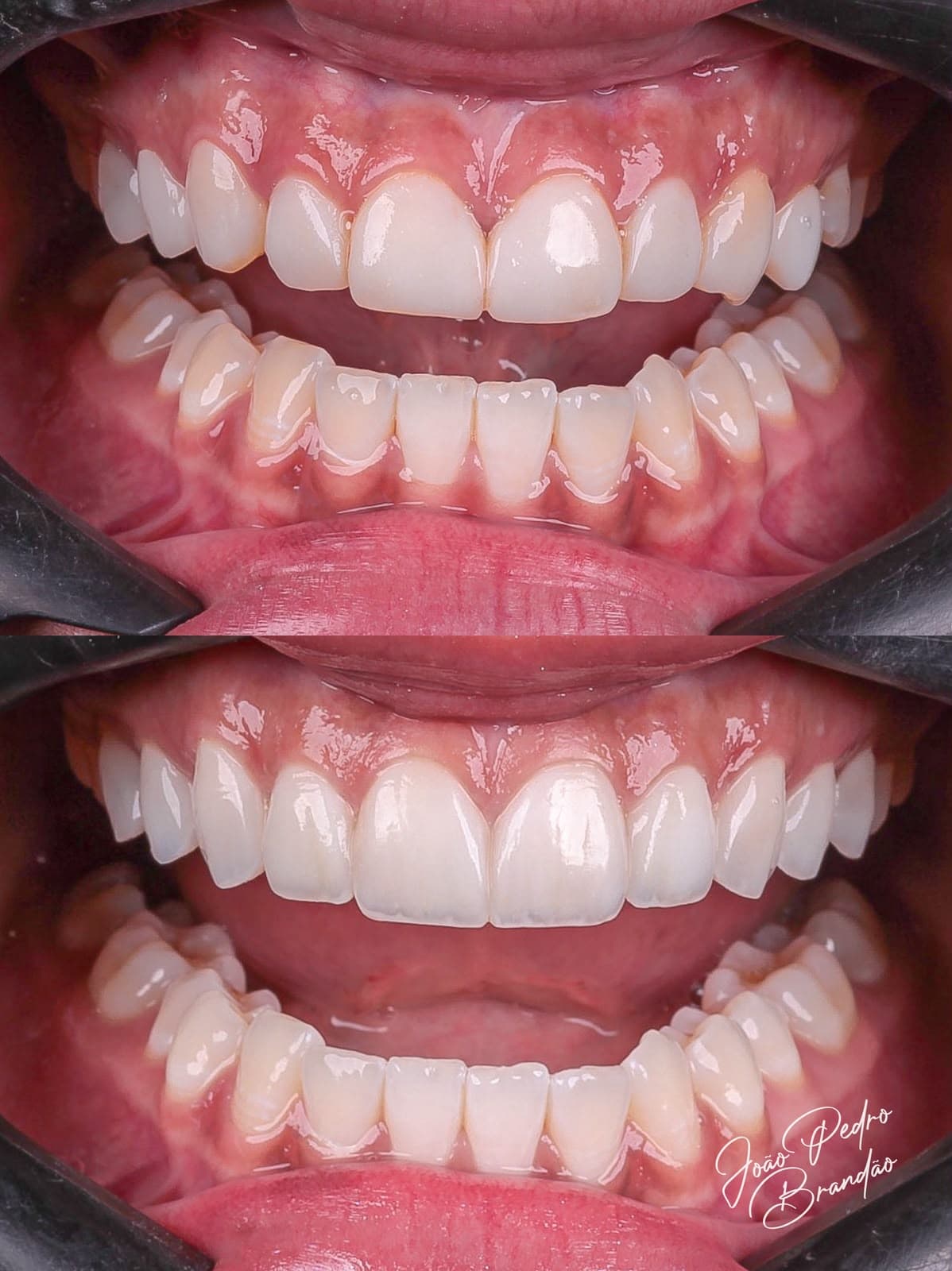 Caso real de facetas em resina composta, antes e depois, tratamento com Dr. João Pedro Brandão