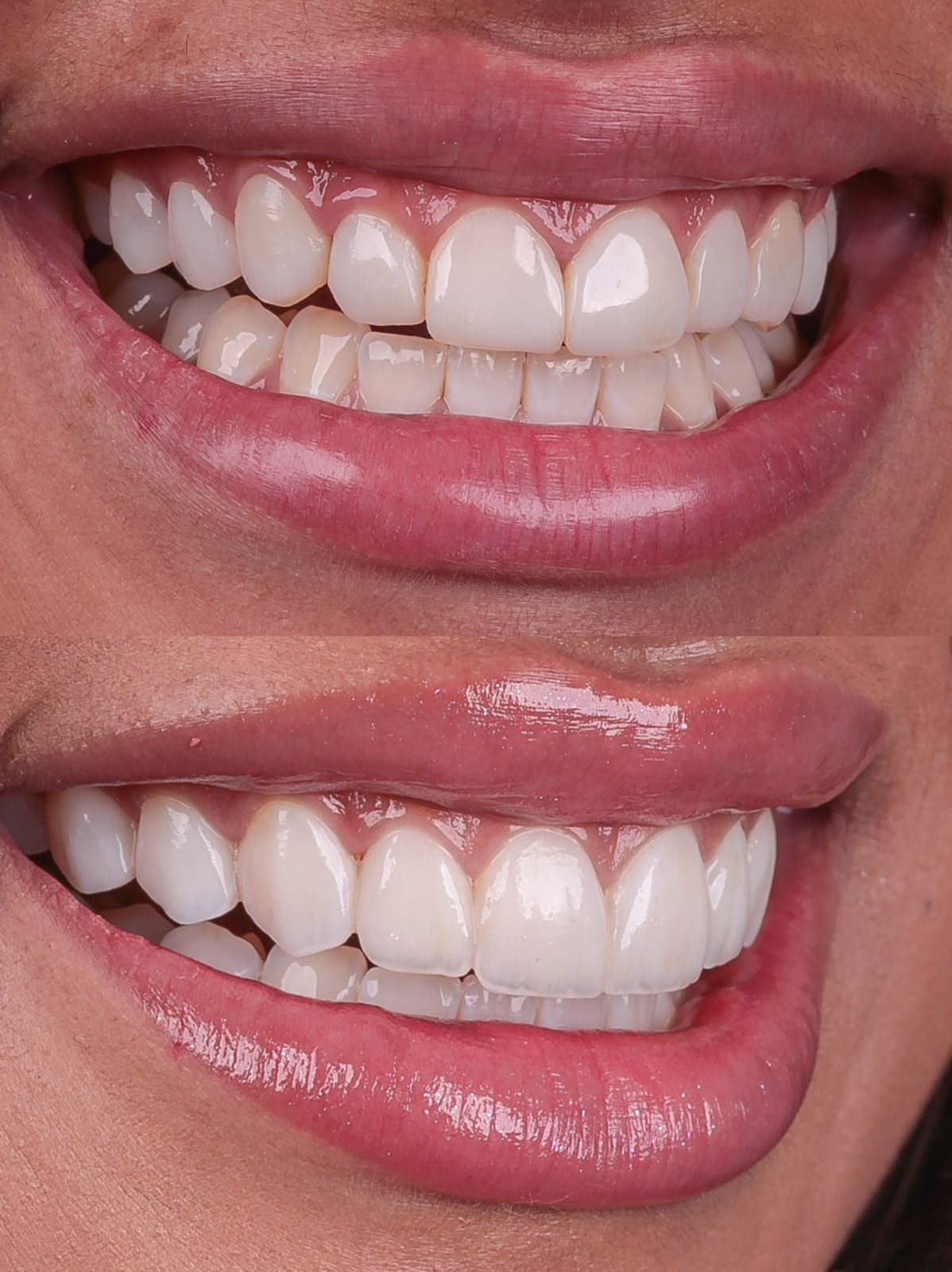 Caso real de facetas em resina composta, antes e depois, tratamento com Dr. João Pedro Brandão
