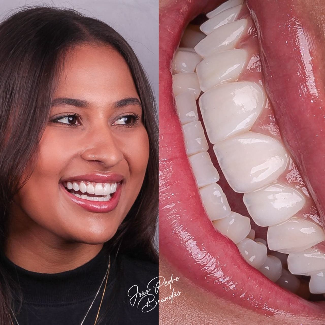 Caso real de facetas em resina composta, antes e depois, tratamento com Dr. João Pedro Brandão
