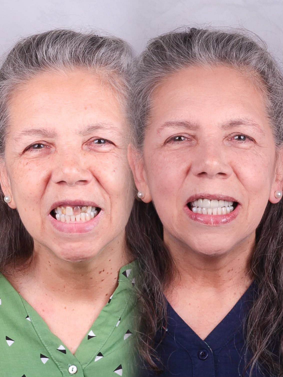 Caso real de facetas em resina composta, antes e depois, tratamento com Dr. João Pedro Brandão