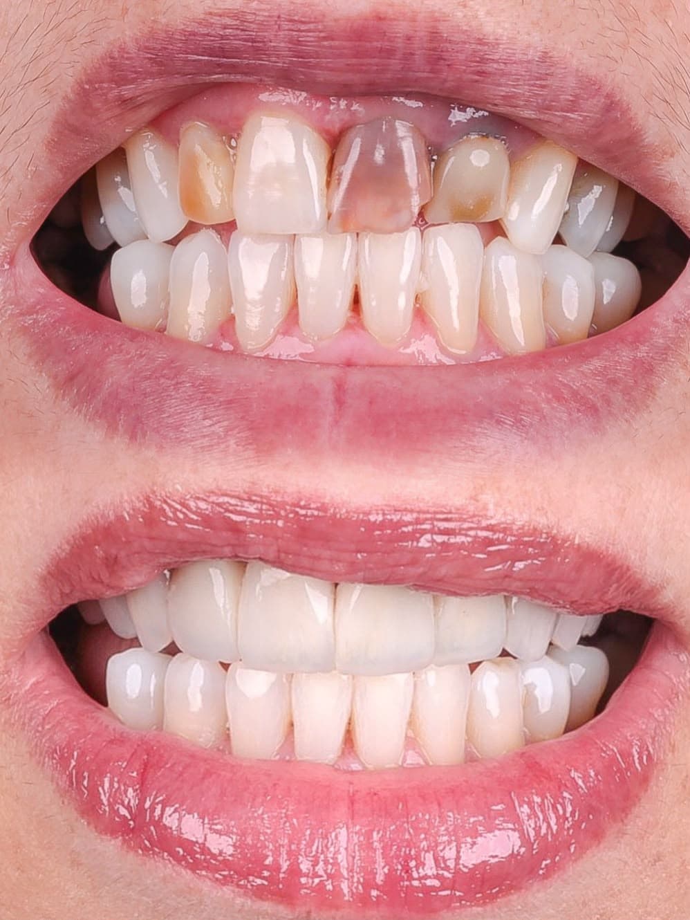 Caso real de facetas em resina composta, antes e depois, tratamento com Dr. João Pedro Brandão
